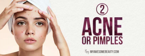 acne medication