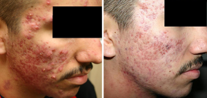 effect of acne