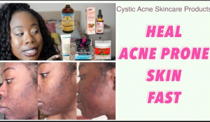 heal acne fast