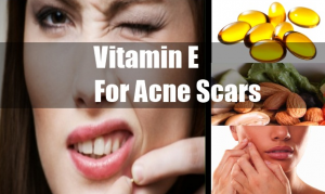 vitamin for acne